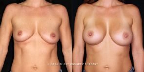 breast-augmentation-20896a-gbc