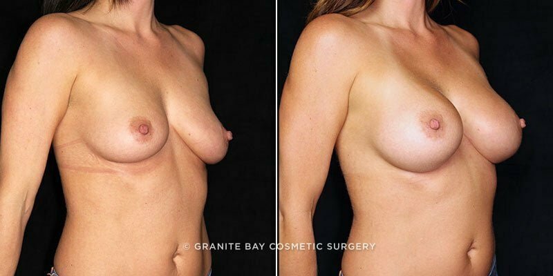 breast-augmentation-20896b-gbc