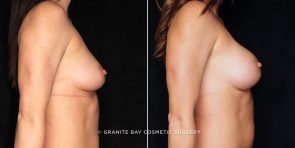 breast-augmentation-20896c-gbc