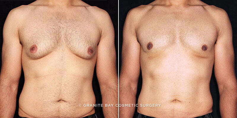 Male Breast Reduction