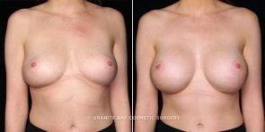breast-augmentation-20182a-gbc