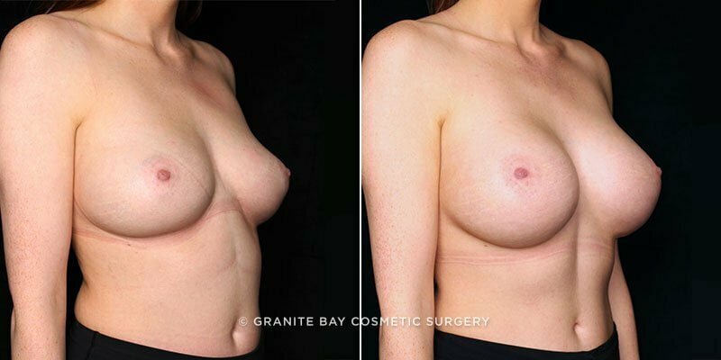 breast-augmentation-20182b-gbc