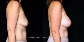 breast-augmentation-21183c-gbc