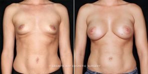 breast-augmentation-21255a-gbc