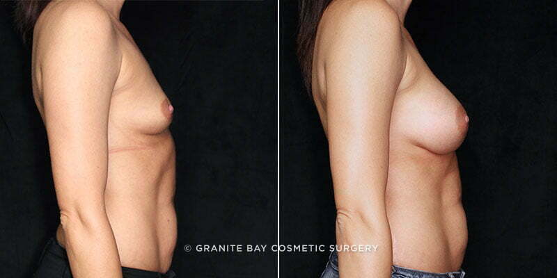 breast-augmentation-21255c-gbc