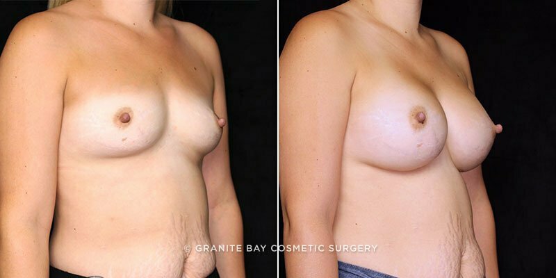 breast-augmentation-21509b-gbc