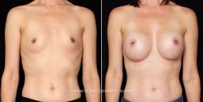 breast-augmentation-21551a-gbc