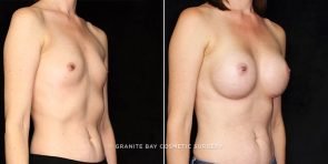 breast-augmentation-21551b-gbc