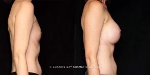 breast-augmentation-21551c-gbc