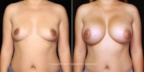 breast-augmentation-21627a-gbc