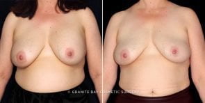breast-implant-removal-19797a-gbc