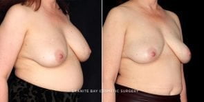 breast-implant-removal-19797b-gbc