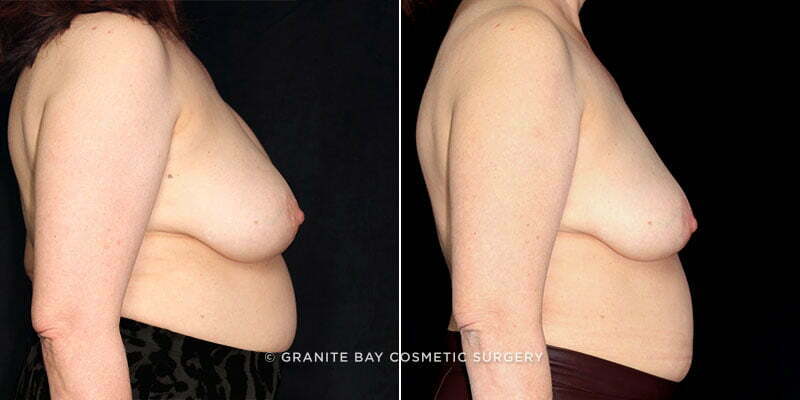 breast-implant-removal-19797c-gbc