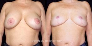 breast-implant-removal-with-lift-21633a-gbc
