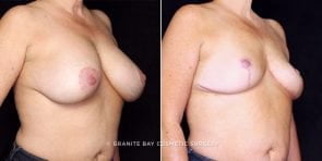 breast-implant-removal-with-lift-21633b-gbc
