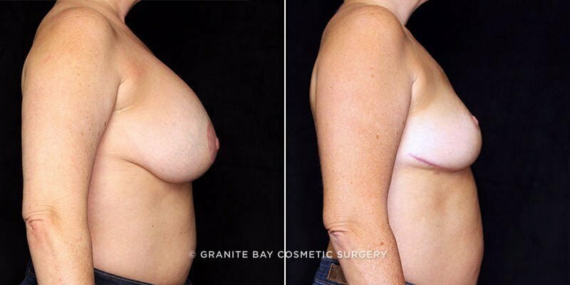 breast-implant-removal-with-lift-21633c-gbc