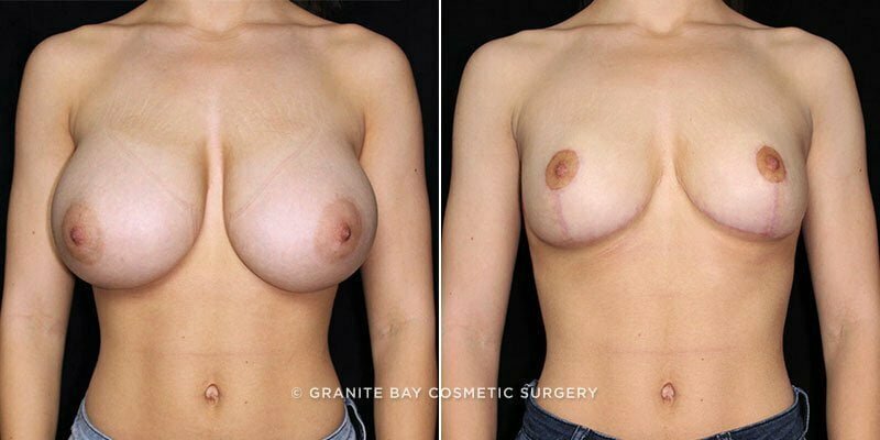 Breast Reduction