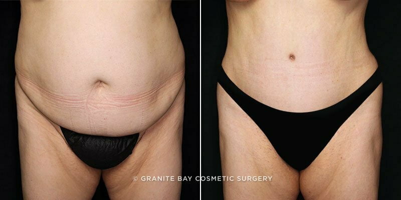 tummy-tuck-liposuction-21358a-gbc