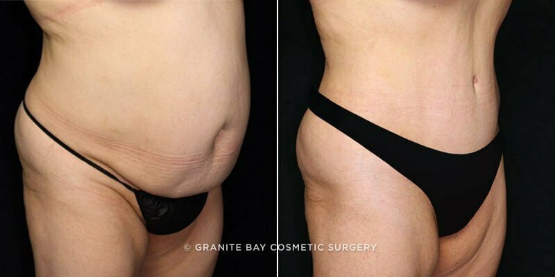tummy-tuck-liposuction-21358b-gbc