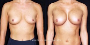 breast-augmentation-17583a-gbc