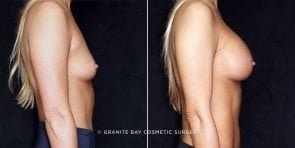 breast-augmentation-17583c-gbc