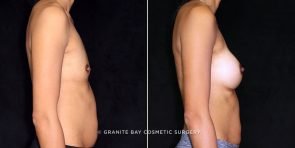 breast-augmentation-21426c-gbc