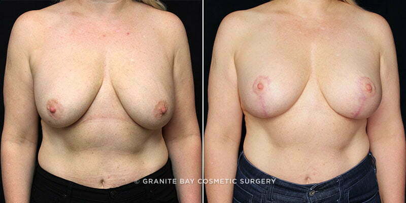 breast-revision-lift-with-implants-20465a-gbc