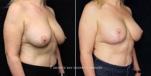 breast-revision-lift-with-implants-20465b-gbc