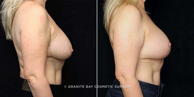 breast-revision-lift-with-implants-20465c-gbc