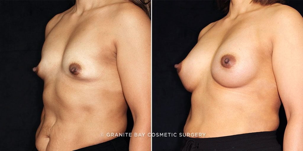 breast-augmentation-17877-b-gbc