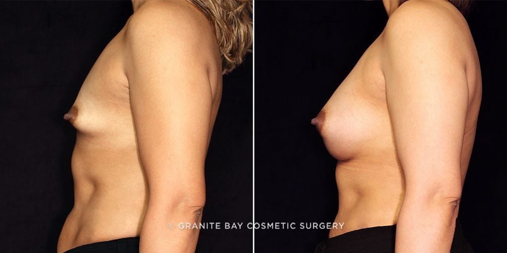 breast-augmentation-17877-c-gbc