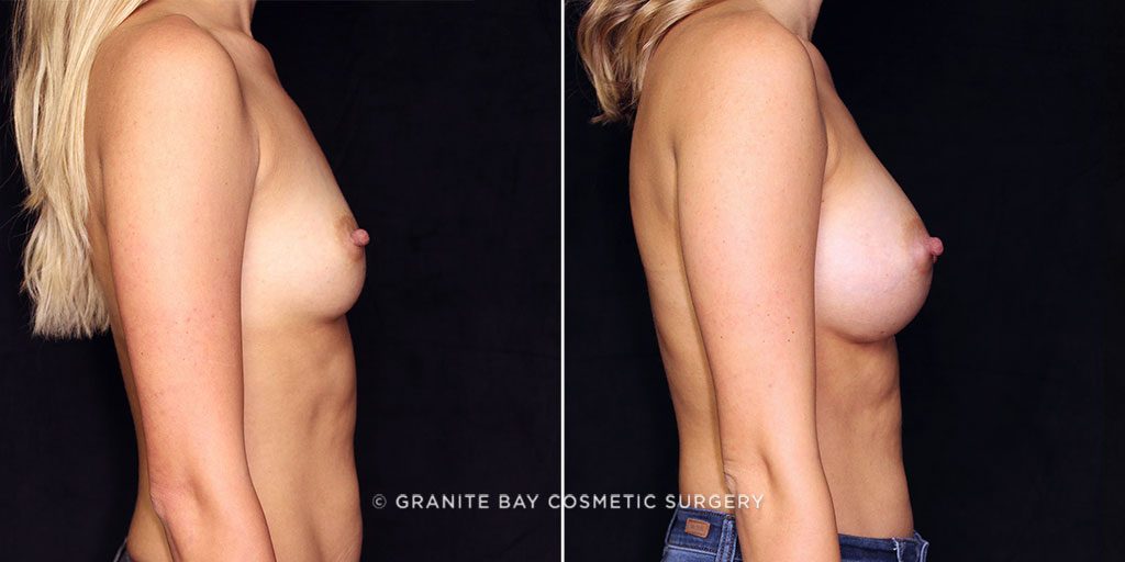 breast-augmentation-21512c-gbc