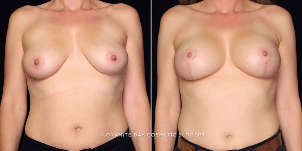 breast-lift-with-implants-22627a-gbc