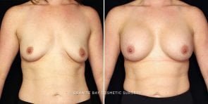 breast-augmentation-22058a-gbc