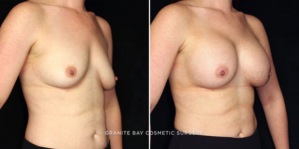 breast-augmentation-22058b-gbc