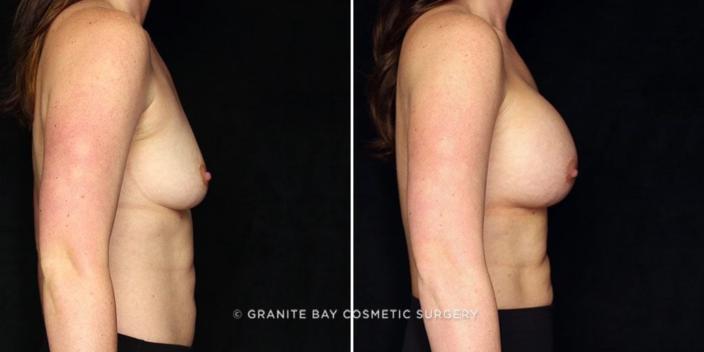 breast-augmentation-22058c-gbc