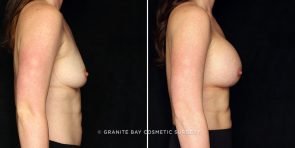 breast-augmentation-22058c-gbc