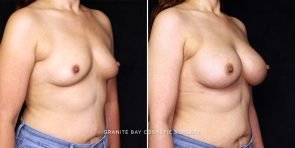 breast-augmentation-22138b-gbc