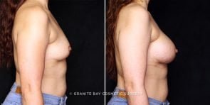breast-augmentation-22138c-gbc