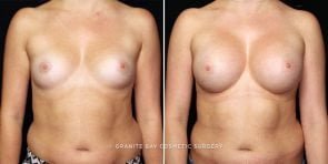breast-augmentation-22247a-gbc