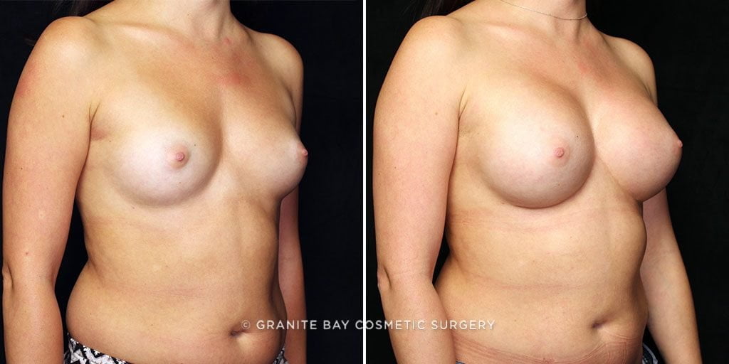 breast-augmentation-22247b-gbc