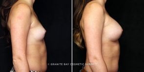 breast-augmentation-22247c-gbc