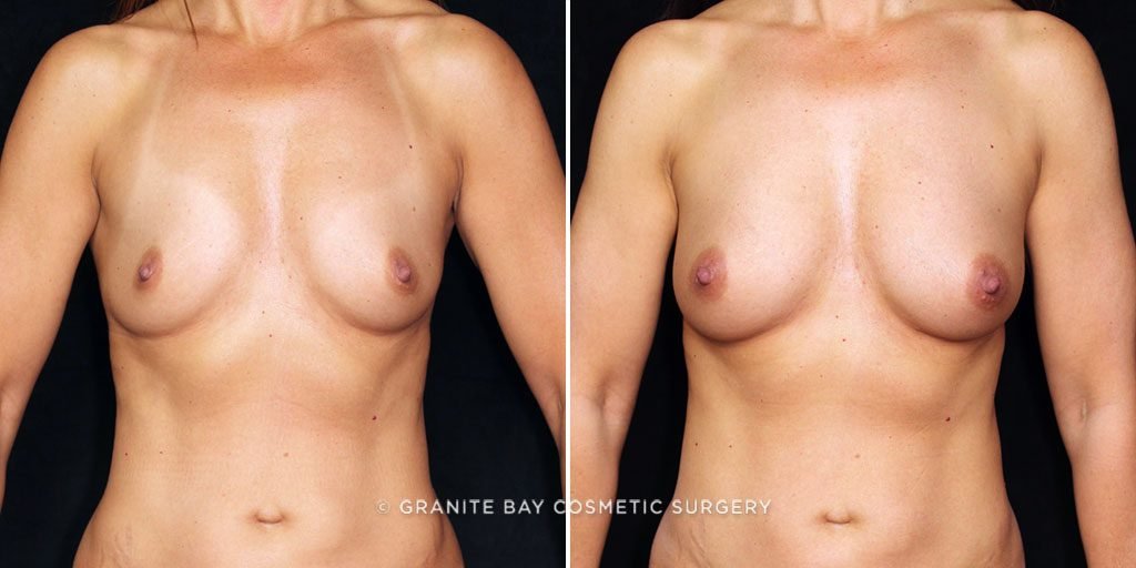 Breast Augmentation with Fat Transfer
