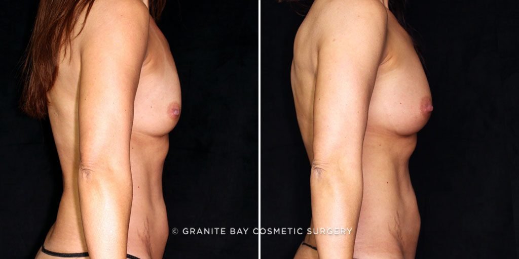 breast-augmentation-fat-transfer-22558c-gbc