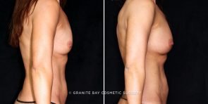 breast-augmentation-fat-transfer-22558c-gbc