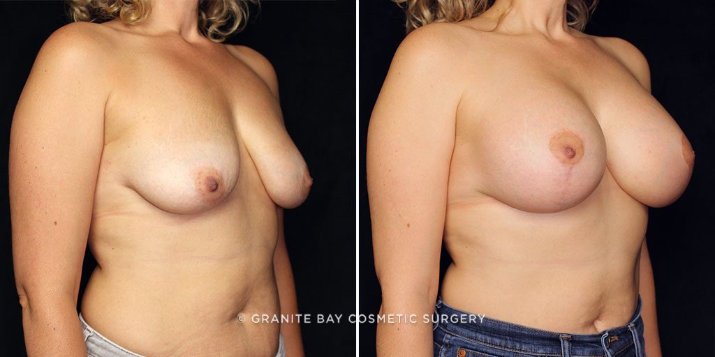 breast-augmentation-with-implants-20304b-gbc