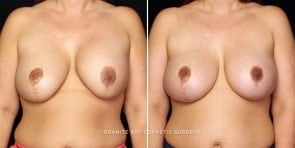 breast-implant-exchange-22345a-gbc