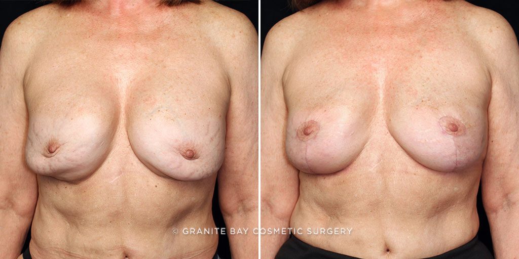 Breast Revision Implant Exchange with Lift