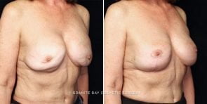 breast-implant-exchange-lift-22160b-gbc