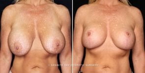 breast-implant-exchange-lift-22274a-gbc
